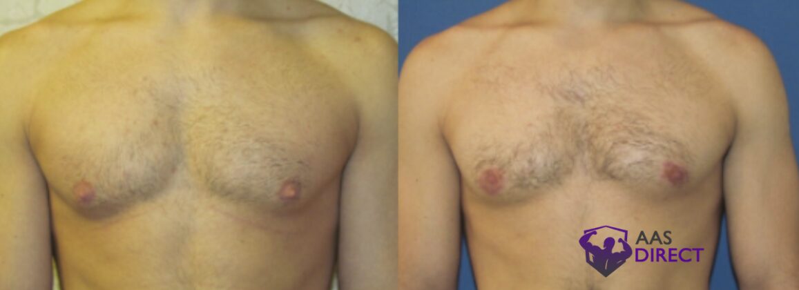 Gynecomastia Development